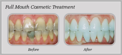 Full Mouth Cosmetic Treatment in Portland