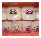 Managing Accidents to Dental Braces or Appliances