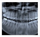 Wisdom Teeth Removal, wisdom tooth surgery, impacted tooth removal