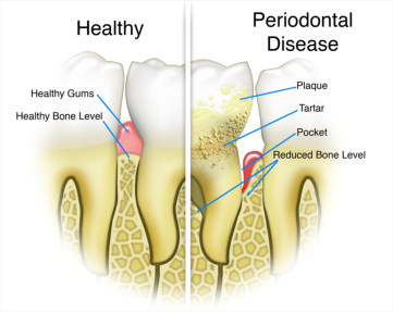 prevention of gum disease