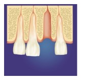 periodontal bone graft