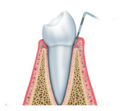 Periodontal Scaling & Root Planing