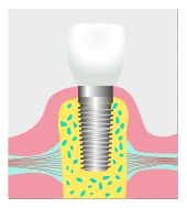 dental implant Tujunga