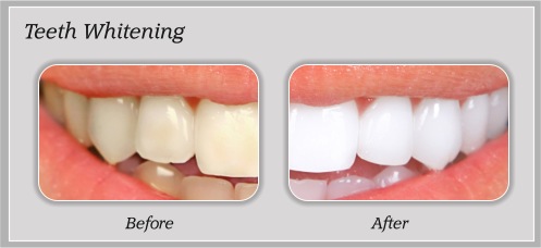 Michael J. Whitted & Associates - Teeth Whitening