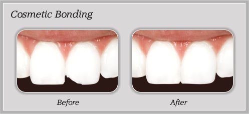 Cosmetic Bonding, Larwin Square Dentistry
