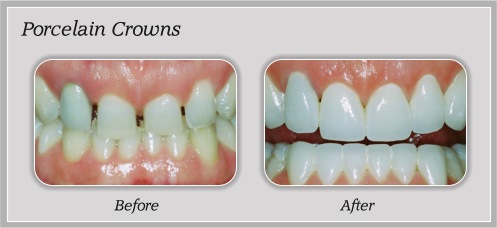 smile gallery porcelain crowns