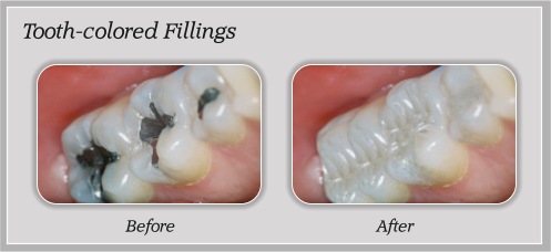 smile gallery tooth-colored fillings