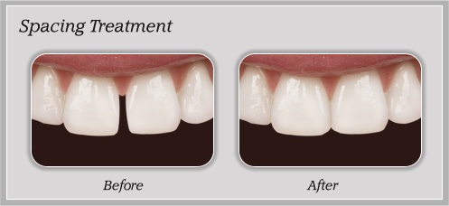 Spacing Treatment, Larwin Square Dentistry