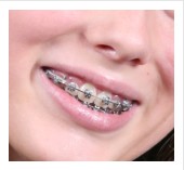 dental braces types