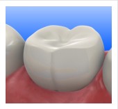 Pournik DDS - Composite and Tooth Color Fillings, Cosmetic tooth fillings